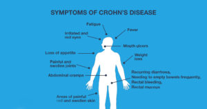 A graphic showing some of the symptoms of Crohn's disease - a form of inflammatory bowel disease (IBD).